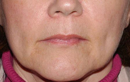 Juvederm and Restylane