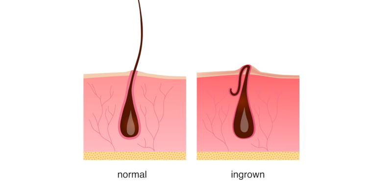 Ingrown Hairs: How to Treat Them Professionally to Prevent Infection