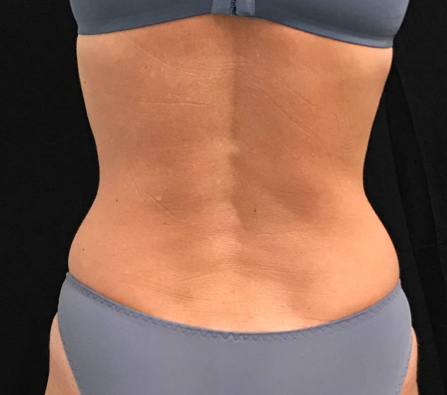 Body Contouring Procedures In Greenwood, South Carolina