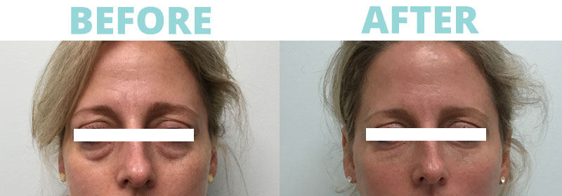 Combo Botox/Fillers